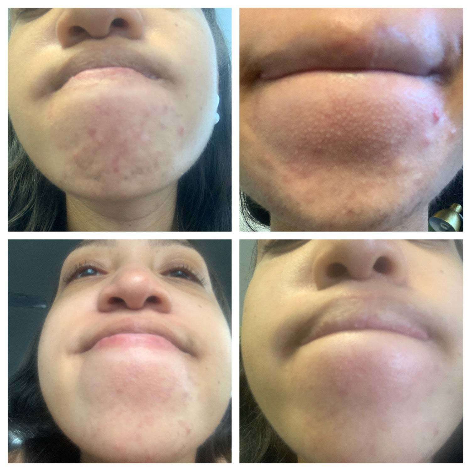Pregnancy Acne Treatment Kit by The Spoiled Mama